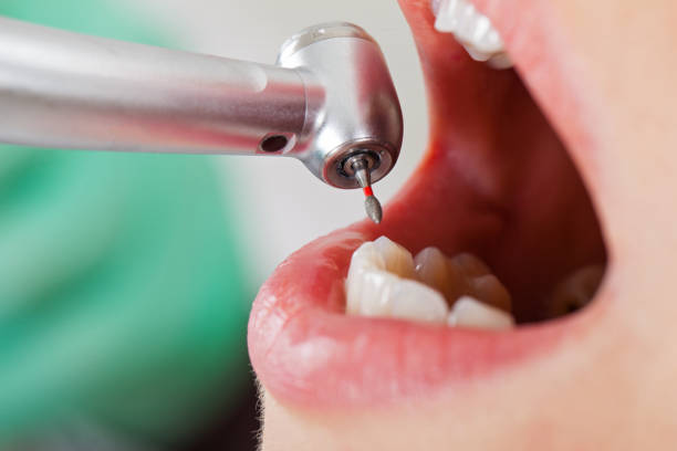 Best Emergency Wisdom Tooth Extraction in Roseburg, OR
